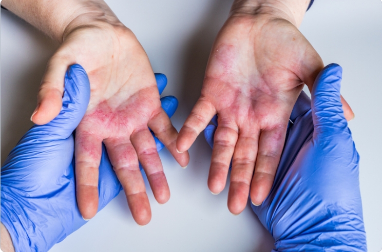 Transforming Atopic Dermatitis into Radiant Health and Beauty with Bai Yin Qigong