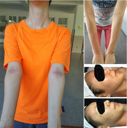 Miraculous Qigong: 1.5 Years of Rejuvenation! Surprising Weight Loss and Improvements to Scoliosis and Bow Legs